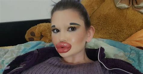 Woman With World S Biggest Lips Wants To Look Like A Human Bratz Doll World News Mirror Online