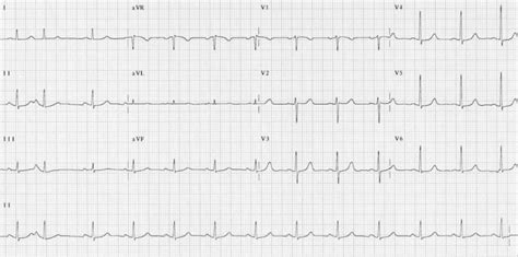 Supraventricular Tachycardia Svt Litfl Ecg Library Diagnosis