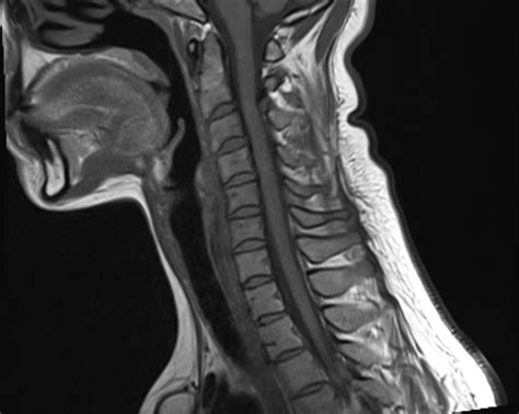 Spina Bifida Occulta Cervical Spine Image