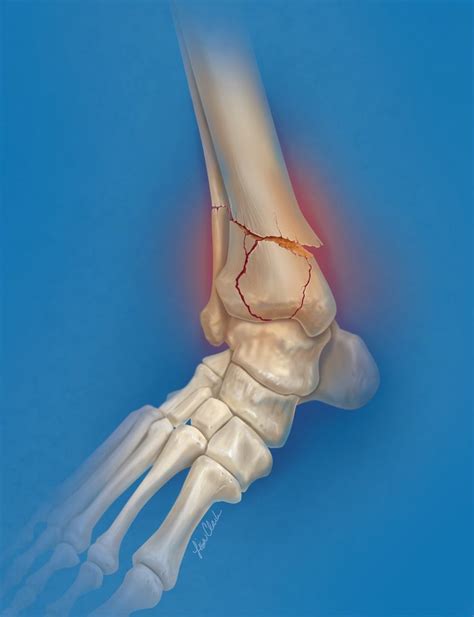 Ankle Fracture Clark Medical Illustration