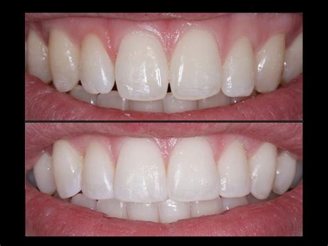 Composite Bonding