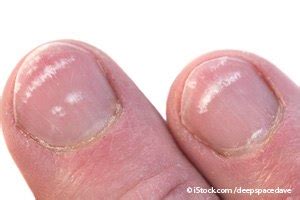 When they are deeper and more formed under the nail, they are called mees' lines. 10 Pictures of What Your Nails Say about Your Health
