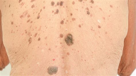 What Are Liver Spots On Skin