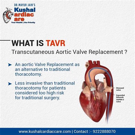 What Is Tavr Transcutaneous Aortic Valve Replacement Aortic Valve