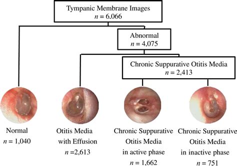 Acute Otitis Media Stages