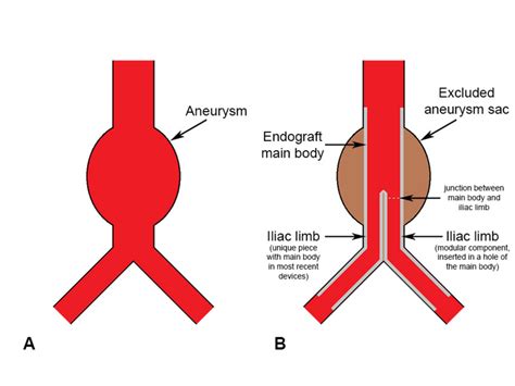 A Schematic Representation Of An Abdominal Aortic Aneurysm Aaa B