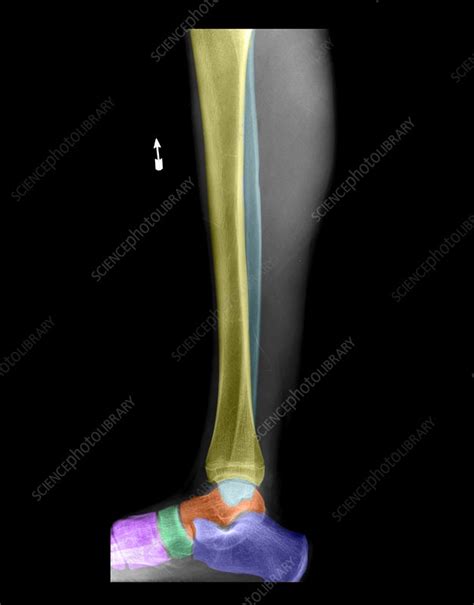 Lower Leg Anatomy Stock Image C0034661 Science Photo Library
