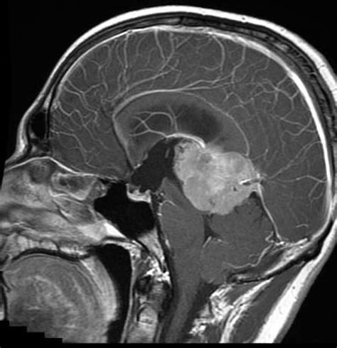 Mri Pineal Tumor Radrounds Radiology Network