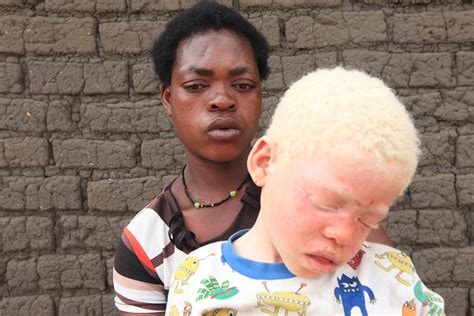 Malawi Albinos Hunted And Murdered For Their Limbs Cbs News