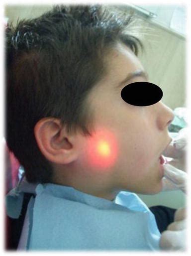 Sialoendoscopy In Juvenile Recurrent Parotitis That Could Be Primary
