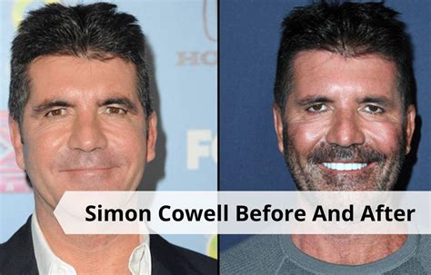 Simon Cowell Before And After Pictures What Happened With Simon Cowell