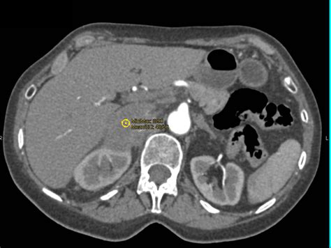 Adrenal Metastases From Lung Primary With Adrenal Artery Feeding Mass