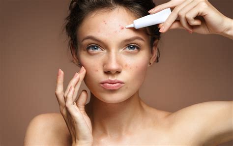 Is Acne A Contagious Skin Condition