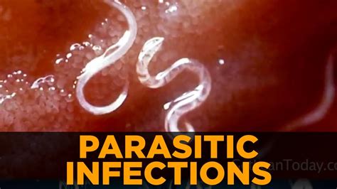 Parasitic Infections And Symptoms From Parasites Youtube