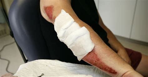 How To Treat Road Rash After A Motorcycle Crash
