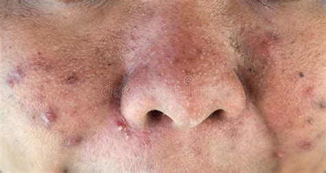 Acne On Facial Skin Dermatological Disease Acne Stock Photo Image Of Disorders Health