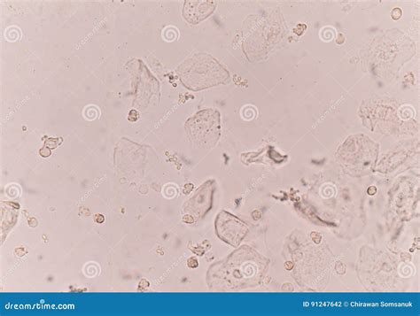 Epithelial Cells In Urine