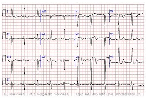 Are You Missing Subtle Mi Clues On Ecgs Test Your Skills