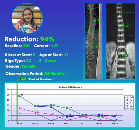 Can Scoliosis Be Cured Without Surgery By Dr Matt Janzen Medium