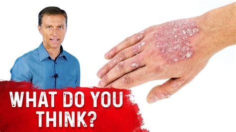 What Is Psoriasis And Is Psoriasis Contagious Explained By Drberg