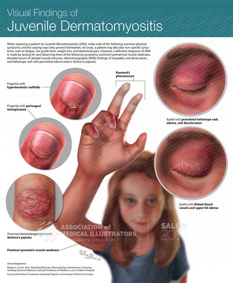 Visual Findings In Juvenile Dermatomyositis Ami Cleveland 2015