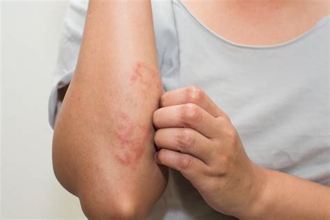 How To Tell Whether That Itchy Rash Is Eczema Or Psoriasis Hk
