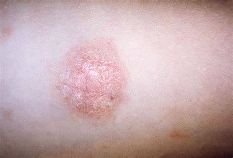 Called a herald patch, this spot can be up to 4 inches (10 centimeters) across. Precise cause of pityriasis rosea remains elusive | MDedge ...