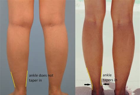 9 Ways To Get Rid Of Cankles