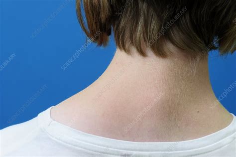 Enlarged Trapezius Muscle Of Shoulder Stock Image C0103298