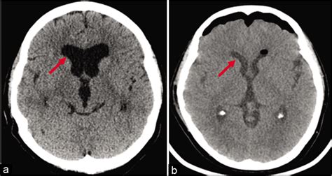 A Case Of Hydrocephalus Confounded By Suprasellar Arachnoid Cyst And