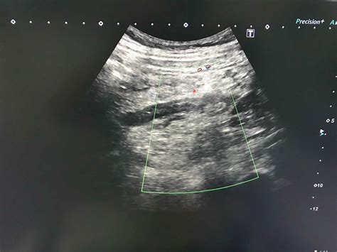Vietnamese Medic Ultrasound Case 548 Appendicitis In Pregnancy Dr