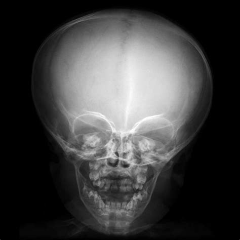 Multiple Radiographs Of A Year Old With Characteristic Features Of