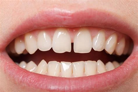 What You Need To Know About Gaps Between Teeth