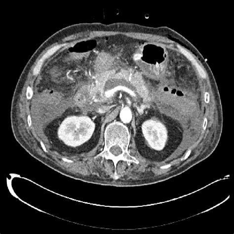 Abdominal Ct Obtained One Week After Embolization Showed No Further