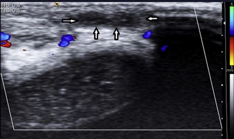 Color Doppler Ultrasound Showing Thrombosis Of The Superficial Dorsal