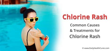 Davon sind dann vor allem die haut, die augen und auch die schleimhäute betroffen. Chlorine Rash: How Long Does It Last and How to Treat It?