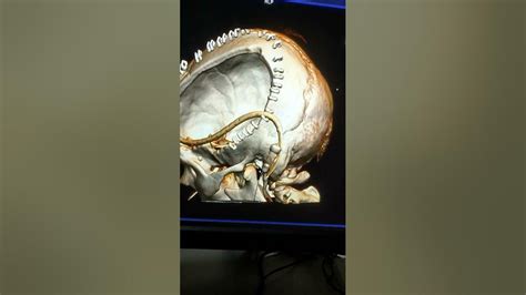 Brain Craniotomy Ct Youtube
