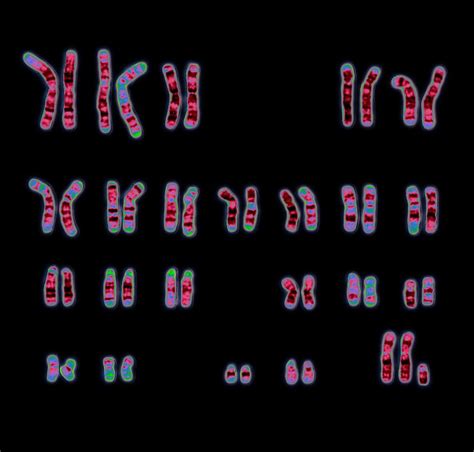 Klinefelter S Syndrome Karyotype Stock Image C Vrogue Co
