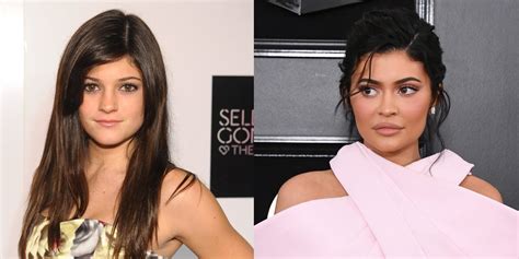 Kylie Jenner Denies Plastic Surgery But Credits Fillers For Her Look