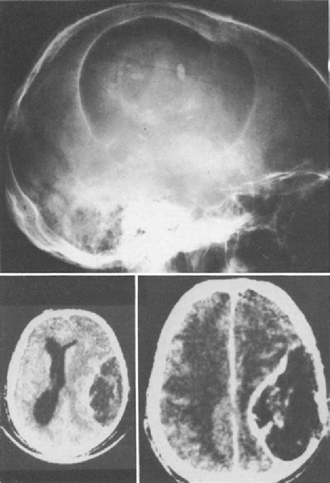 Figure 1 From Giant Intradiploic Epidermoid Cysts Of The Skull Report