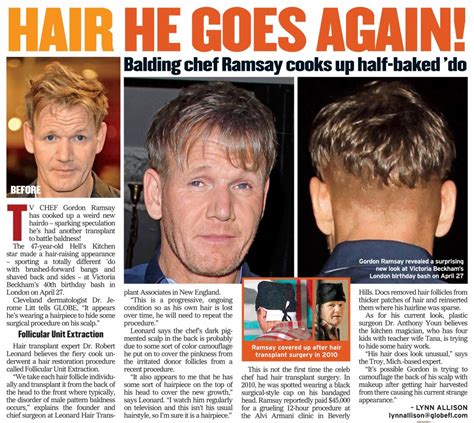 gordon ramsay before and after hair transplant