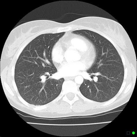 Normal Ct Scan Of Lungs With Contrast