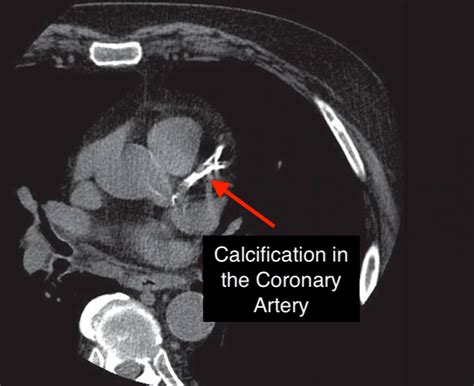 Coronary Artery Calcium Score Cac Revolution Health And Wellness
