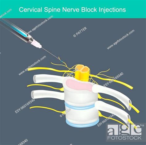 Cervical Spine Nerve Block Injections Illustration For Learning