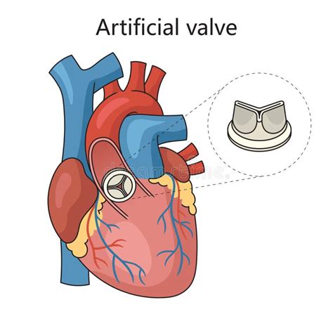 Artificial Heart Valve Stock Illustrations 189 Artificial Heart Valve
