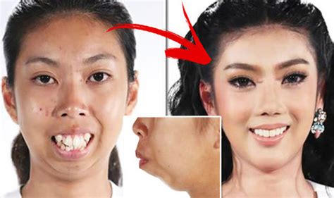 Plastic Surgery Transformation For Thai Woman Who Needs Chin Implant Life Life And Style