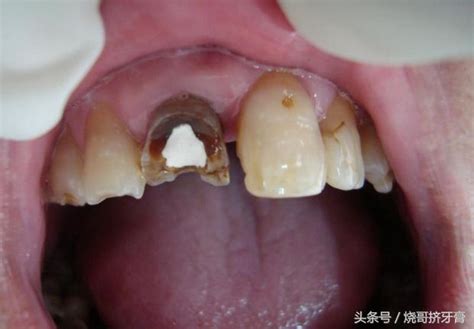牙齒做根管治療真的會痛嗎？ 每日頭條