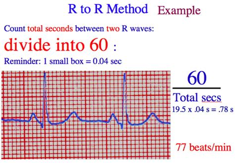 How To Calculate Heart Rate From Ecg With Regular Rhythm Photos Idea