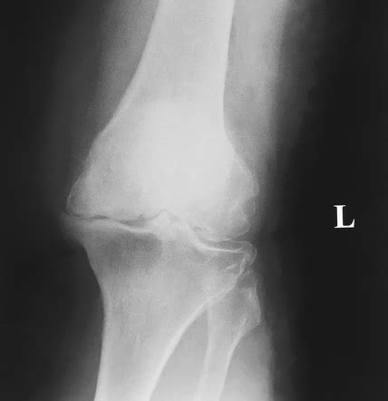 Osteoarthritis Of The Knee Radiology Reference Article Radiopaedia Org