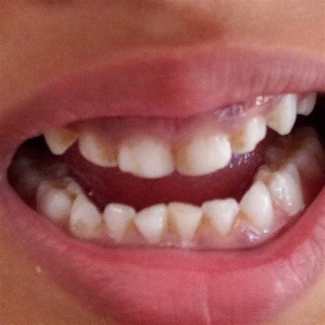 Asktheexpert My Baby Has Become 8 Years 26 Days Old But His Teeth Hove